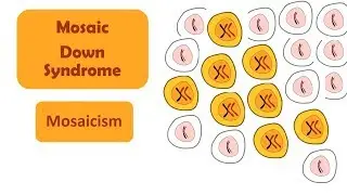 Mosaic Down Syndrome | Mosaicism | A type of Down Syndrome