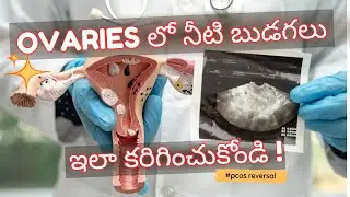 How to Shrink Ovarian Cysts | Ovarian Cyst Cure | PCOD and PCOS diet plan | Dr Harika Kuppala