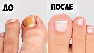 Лечение вросшего ногтя ✅5 способов удалить вросший ноготь в домашних условиях