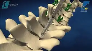 Stryker (K2M): CASPIAN Mini DENALI Surgical Technique Animation