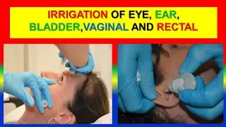 IRRIGATION OF EYE, EAR, BLADDER,VAGINAL AND RECTAL -  define,  purposes ,steps Nursing Foundations