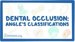 Dental occlusion - Angle’s classifications