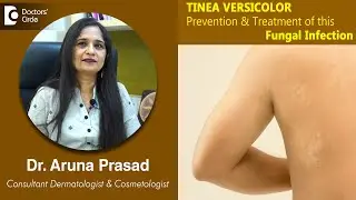 White Patches on Skin. Is it TINEA VERSICOLOR - Is it Fungal ? -Dr.Aruna Prasad | Doctors' Circle