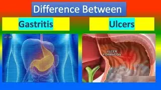 Difference Between Gastritis and. Ulcers