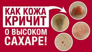 Самый БЫСТРЫЙ тест на глюкозу в крови / Как выявить САХАРНЫЙ ДИАБЕТ по коже?