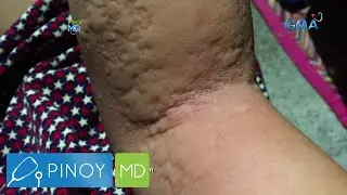 Pinoy MD: Labis na pamamantal, sanhi ng urticaria?