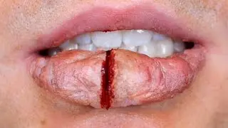 HUGE BUSTED LIP!