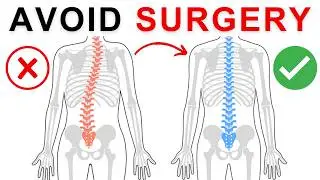 Overlooked Alternatives to Invasive Scoliosis Surgery | Exercises & Tips