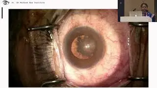AIOC2023 - IC558 - Dr. Tushya om parkash  - Alarm bell situations in cataract phacoemulsification ..