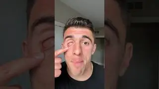 MY EYEBALL STORY 😭