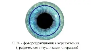 ФРК - 👉 фоторефракционная кератэктомия   - 🎥 видео лазерной коррекции зрения 👀 (инфографика)