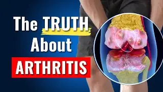 8 Knee Osteoarthritis Lies You've Been Told