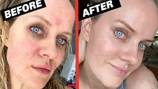 HOW I CURED MY #ROSACEA