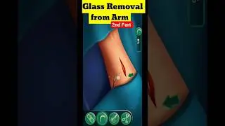 3D Animation of Glass Removal from Arm. 