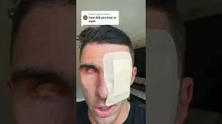 HOW I LOST MY EYEBALLS 😭