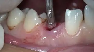 Immediate implants, CTG