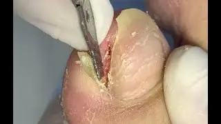 Very thick nail digging