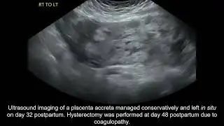 Placenta accreta spectrum conservative management and coagulopathy