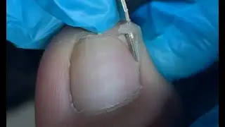 Satisfying ingrown toenail treatment