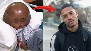 Doctors didn’t give him a chance, but the baby survived and changed beyond recognition!