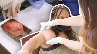 ELLE A UNE ÉNORME BOULE SUR LE BRAS !