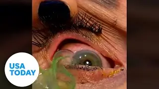 Eye doctor pulls 23 contact lenses from elderly womans eyelid | USA TODAY