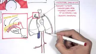 Lung Carcinoma (Lung cancer)