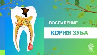 ♦️ Воспаление корня зуба