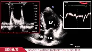 Acute Myocardial Infarction