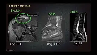 Sports Medicine Case 46: 21-year-old: Tennis-Synovitis: Shoulder Pain and Finger Swelling