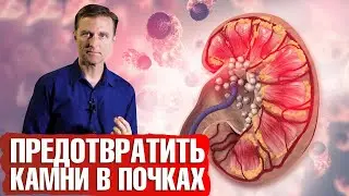 Камни в почках. Высокие оксалаты в моче: что делать😕