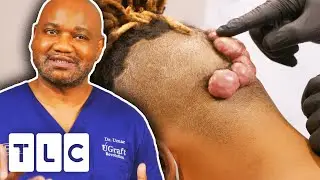 Dr. Sandra Lee & Dr. Umar Treat Very Large Keloids | Dr. Pimple Popper