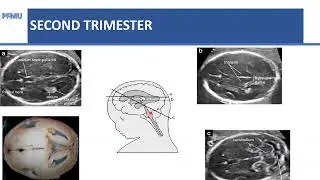 Fetal CNS Abnormalities - Dr. C. Verenga