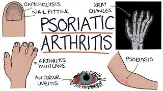 Psoriatic Arthritis