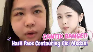 CANTIK BANGET!😍 Hasil Operasi Face Contouring Cici Medan!