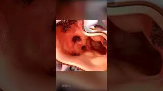 What Is Colonic Diverticulosis
