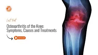 Osteoarthritis of the Knee: Symptoms, Causes and Treatments Part 4