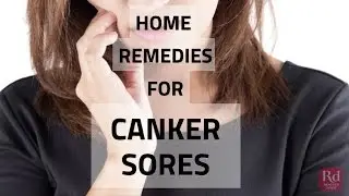 Home Remedies for Canker Sores