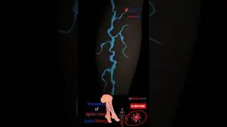 Spider Veins Treatment - ScleroTherapy - Legs Varicose Injection 
