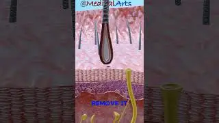 Blackhead video ⚫ Blackhead formation #dermatology