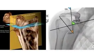 PreOp Planning and Mixed Reality in Reverse Shoulder Arthroplasty