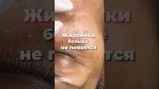 Как удалить Жировик на лице,теле 