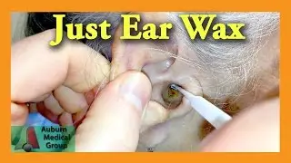 Ear Wax Removal Doctor | Auburn Medical Group