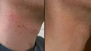 HOW TO CURE RAZOR BURN BUMPS ON NECK & LEGS!