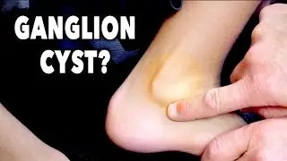 GANGLION CYST? | Dr. Paul