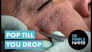 POP TIL YOU DROP! Blackhead Edition