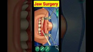 Jaw Surgery #animation #shortvideo #shorts #asmr