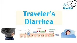 Traveler’s Diarrhea | Causes (Bacteria, Viruses, etc), Risk Factors, Symptoms, Diagnosis, Treatment