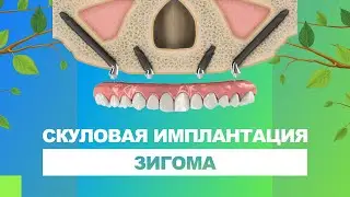 🦷 Скуловая имплантация Зигома / Zygoma