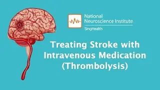 Understanding Stroke: Treating Stroke with Thrombolysis